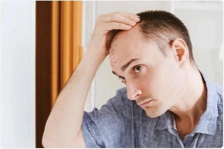 Hair Fillers Vs. Hair Transplants: Which Is Right for You?