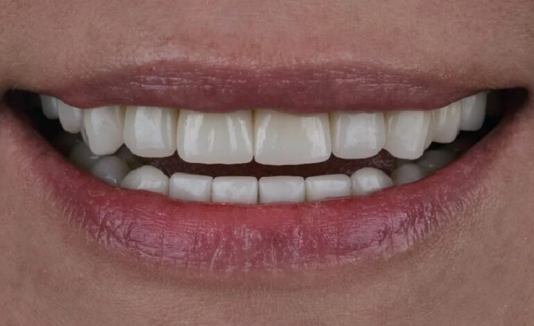 The attractions of dental composite veneers