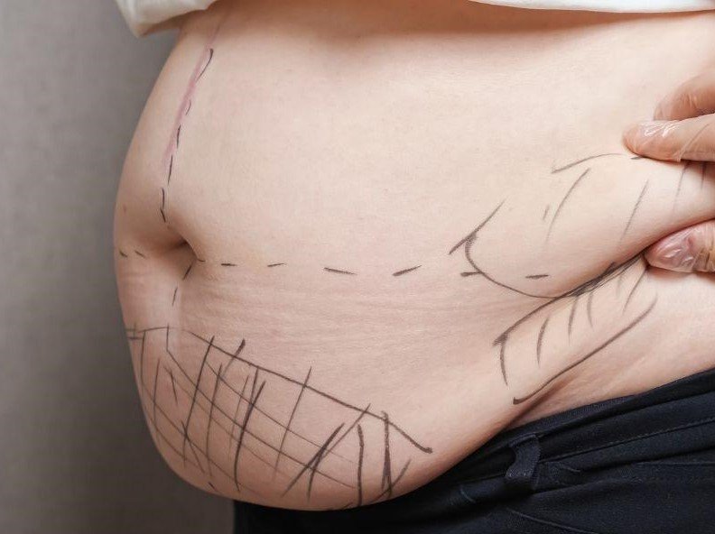 Everything You Need to Know About Liposuction