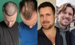 What Are Hair Transplants?