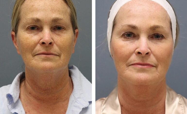 Real Results: Before and After RF Microneedling Transformations