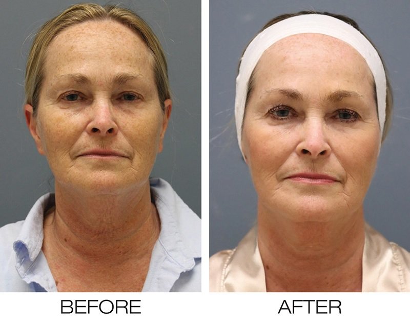 Real Results: Before and After RF Microneedling Transformations