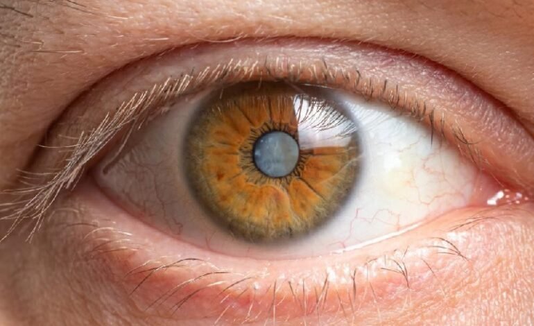 5 Potential Warning Signs of Cataracts